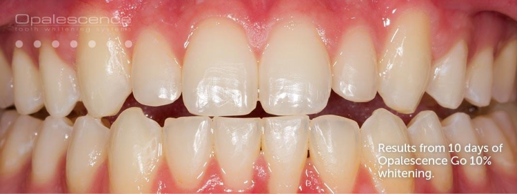 After shot of teeth whitening with Opalescence Go