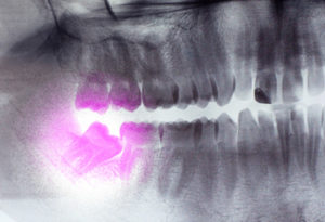 impacted wisdom tooth xray